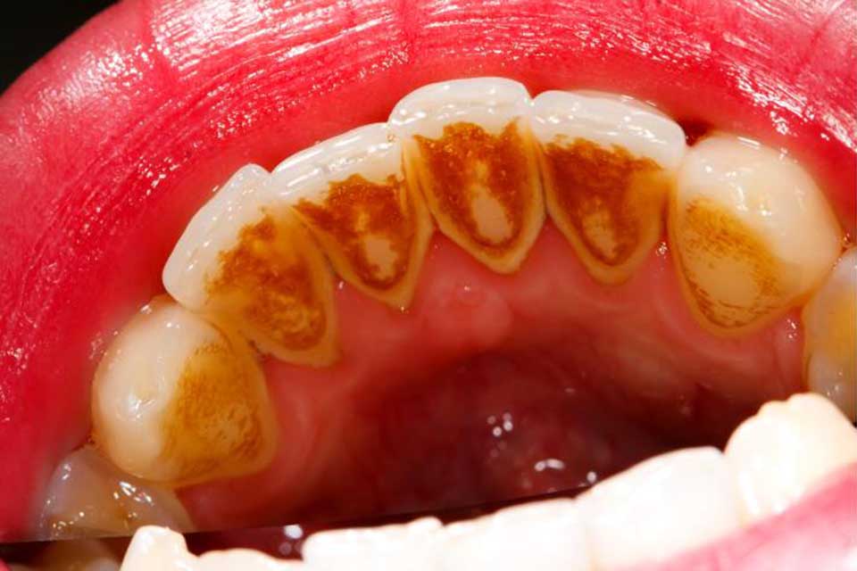 teeth with plaque