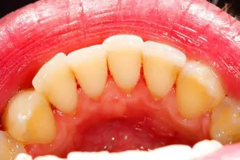 Teeth with no plaque