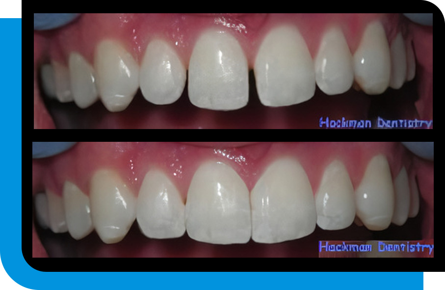 Expert Dental Bonding Service in Atlanta, GA