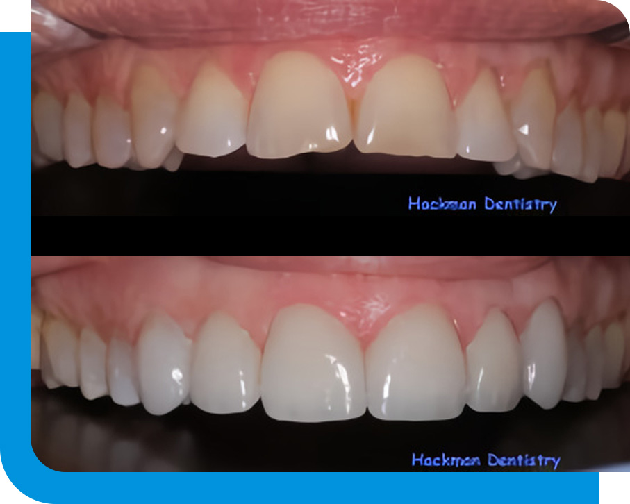 Quality Veneers in Atlanta, GA
