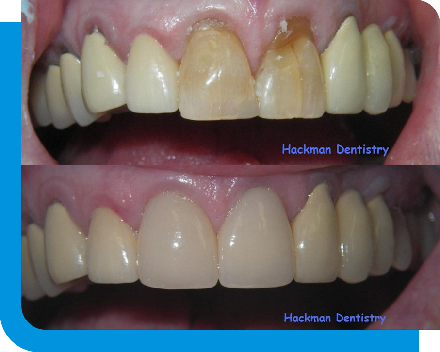 Quality Dental Crowns Service in Atlanta, GA