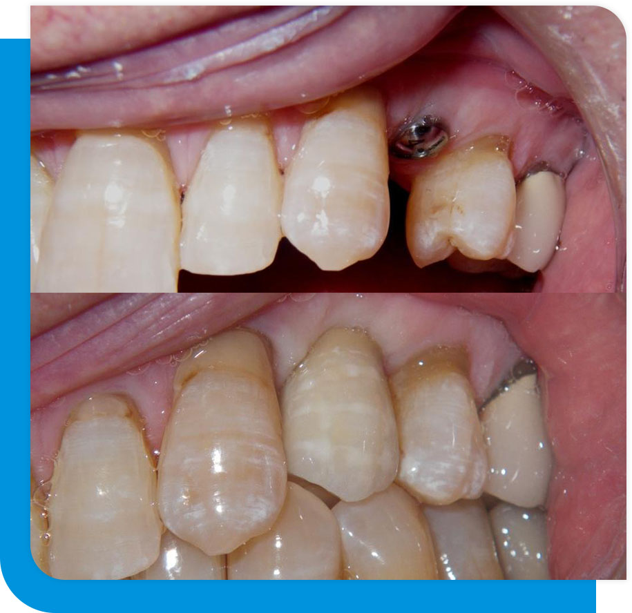 Quality Dental Implant Service in Atlanta, GA