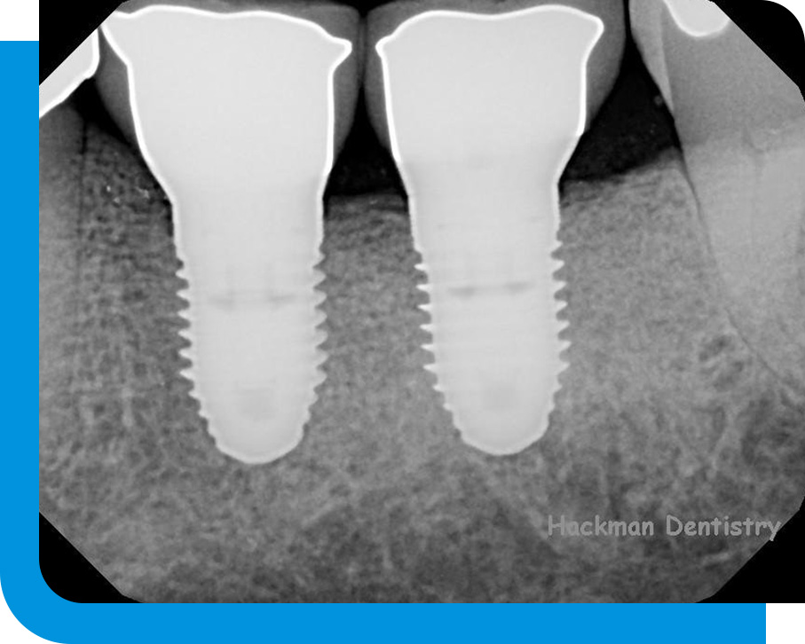 Quality Dental Implant Service in Atlanta, GA