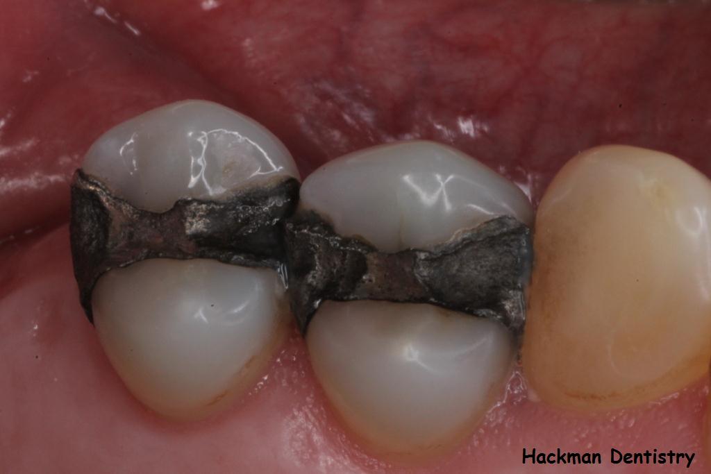 inlays and onlays Inlays and Onlays in Atlanta, GA