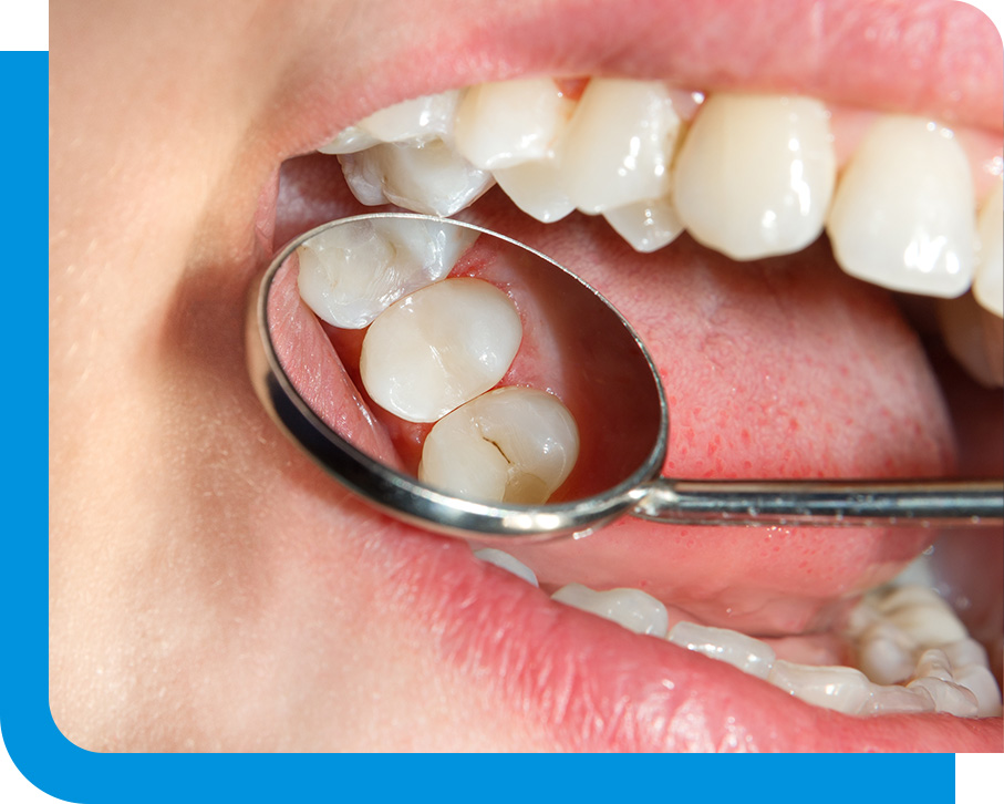 Scaling & Root Planing in Atlanta, GA