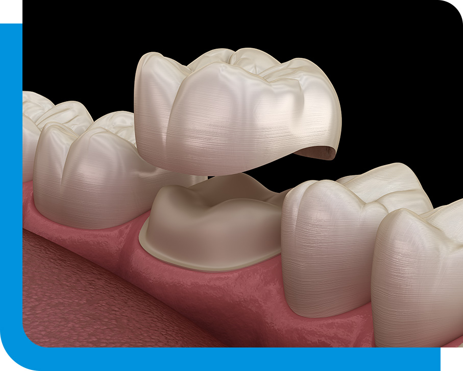 Expert Crown Lengthening in Atlanta, GA