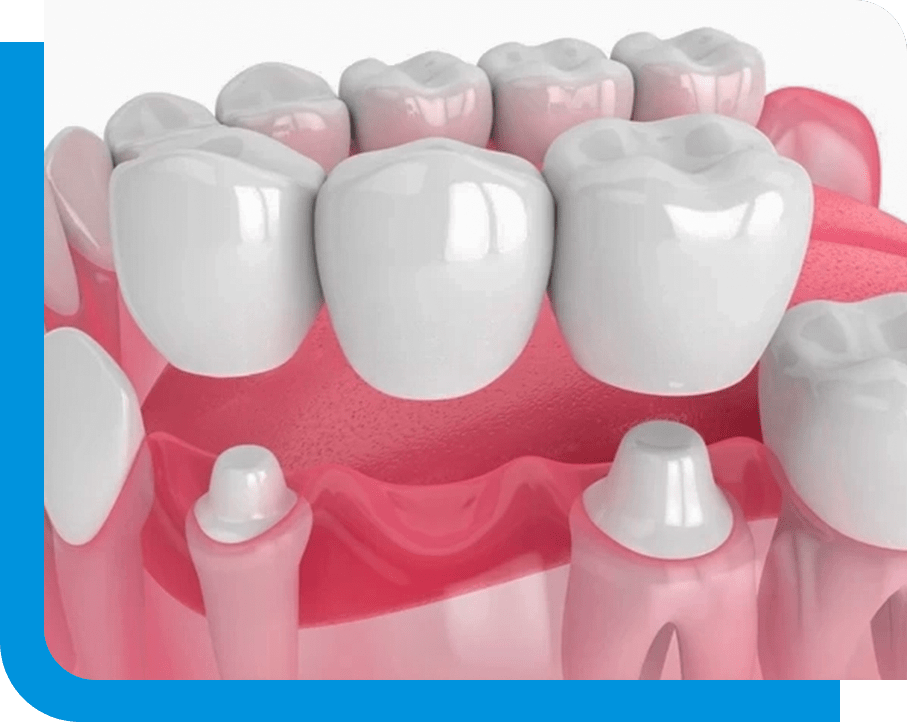 3d render of jaw with dental bridge over white background