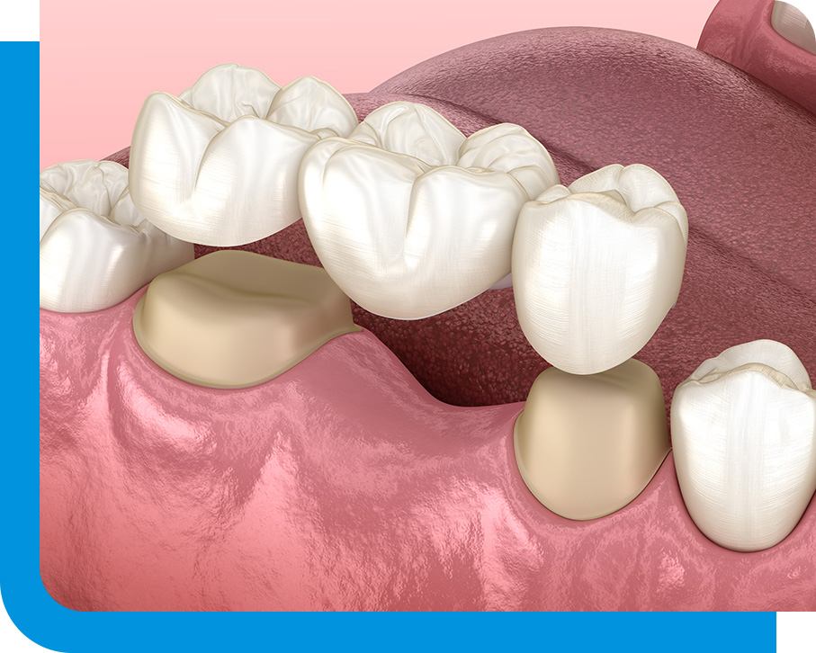 Expert Dental Bridges Service in Atlanta, GA