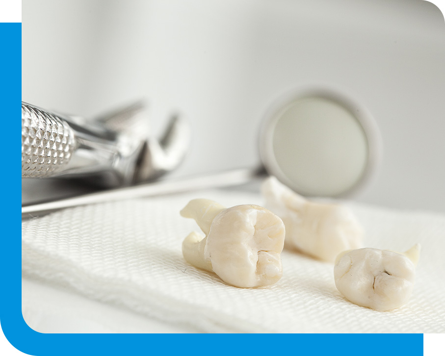 Expert Teeth Extraction Service in Atlanta, GA