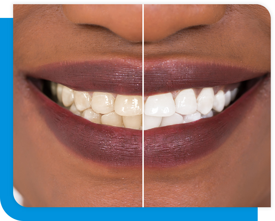 Quality Whitening Procedure in Atlanta, GA