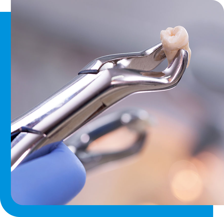 Expert Teeth Extraction Service in Atlanta, GA