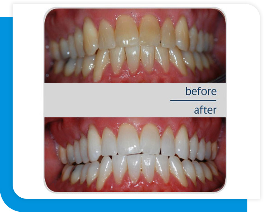Quality Whitening Procedure in Atlanta, GA