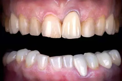 AdobeStock_435079414-a not fixed teeth