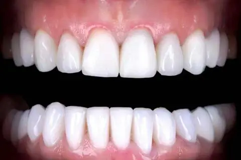 AdobeStock_435079414-b fixed teeth