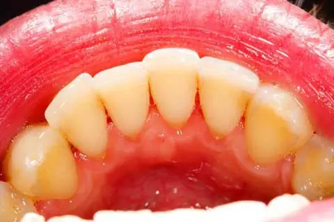 AdobeStock_46527958-a Teeth with no plaque