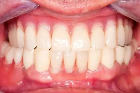 AdobeStock_56187073-a With teeth