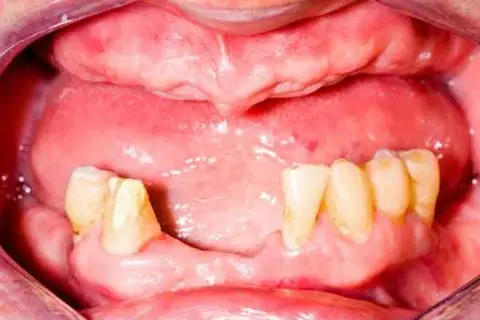 AdobeStock_56187073-b No teeth